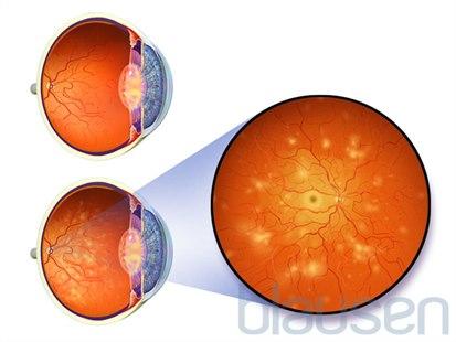 Diabetes retinopathy