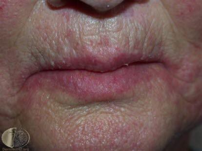 Angular cheilitis