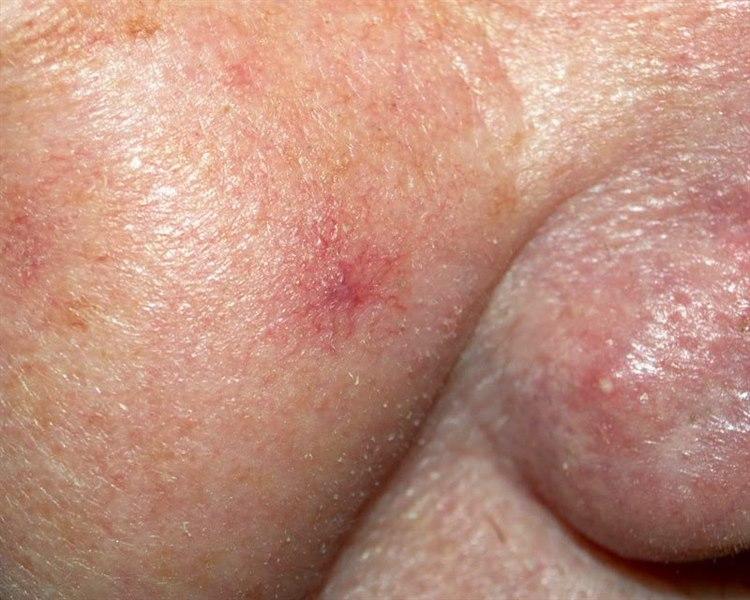 Fotoet viser nærbilde av Stjernenævus ved kinn og nese område