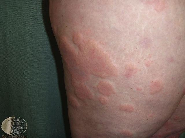 Fotoet viser urtikaria