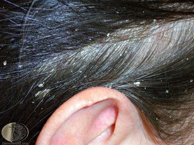 Fotoet viser seboroisk eksem i hodebunn