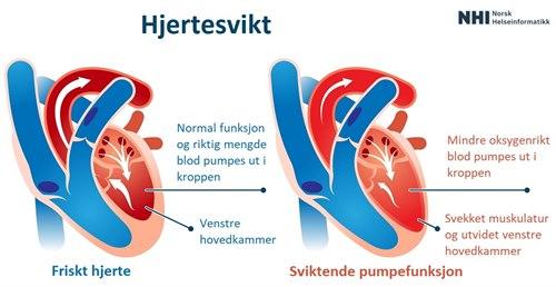 Hjertesvikt.jpg