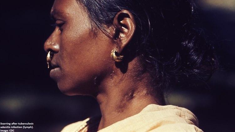 Foto: PHIL - Centers for Disease Control and Prevention:Særlig i andre deler av verden er tuberkulose i andre deler av kroppen enn i lungene et problem. Bildet viser en 20 gammel kvinne fra Pakistan som har fått fjernet en tuberkulose-infisert lymfeknute på halsen .