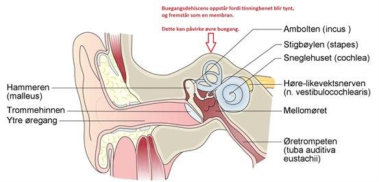 superior semicircular canal dehiscence syndrome