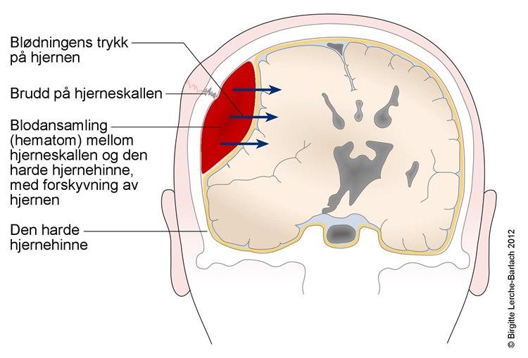 Blodansamling epiduralt 