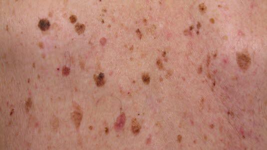 Seboriske vorter utsnitt