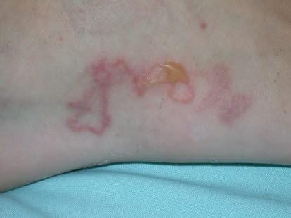 Fotoet viser kutan larva migrans