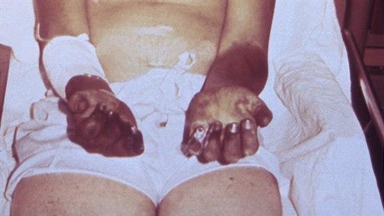 Foto viser utsnitt av midtpartiet til en person. Huden er lys, bortsett fra hendene som er veldig mørke.