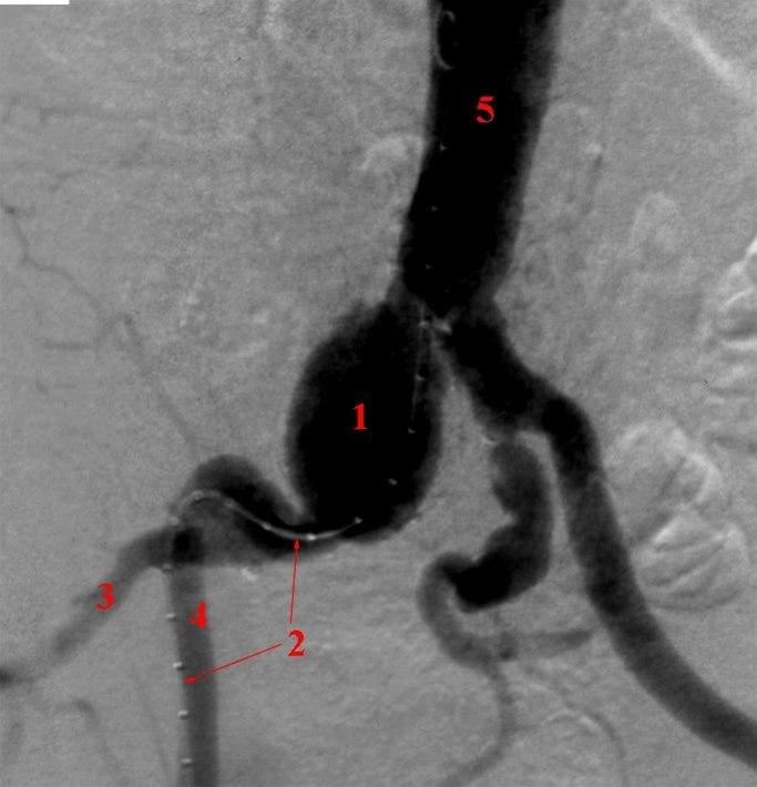 Bekkenarterie-aneurisme