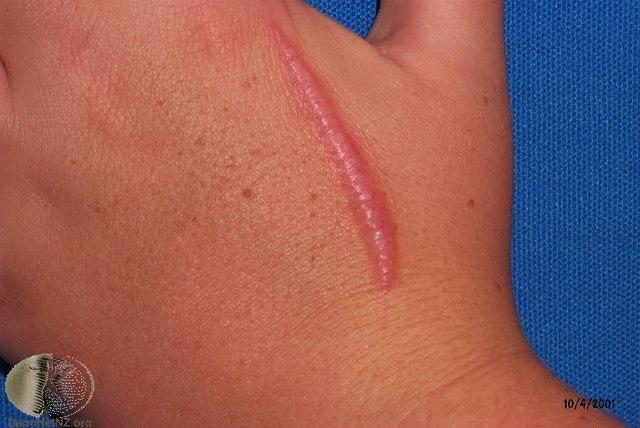 Fotoet viser hypertrofisk arr