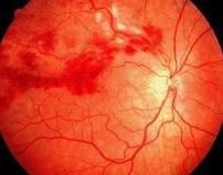 Hypertensiv retinopati.jpg