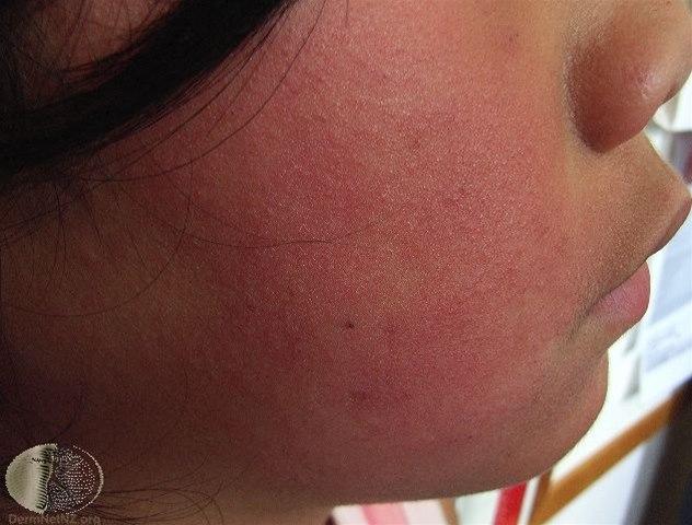 Fotoet viser femte barnesykdom, kinn