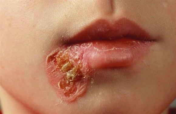 Brennkopper (impetigo) ved leppe