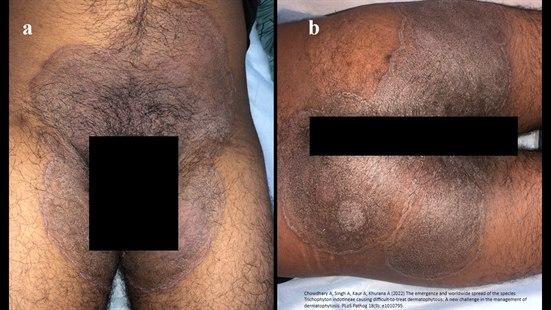 Bilde som viser mann med utslett i skritt/rumpe (2 bilder) som skyldes Trichophyton. Stort sopputslett. 