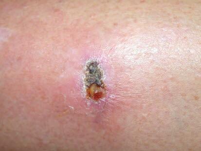 Fremmedlegeme i huden