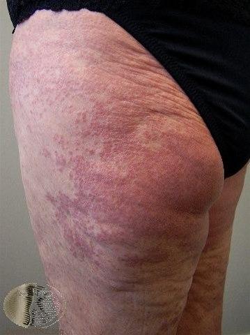 Fotoet viser granuloma annulare, utbredt