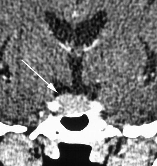 Hypofysetumor (CT)