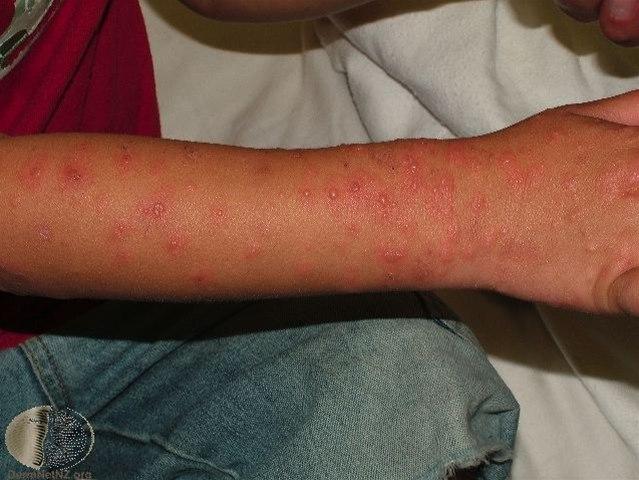 Fotoet viser erythema multiforme, arm