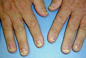 Neglepsoriasis