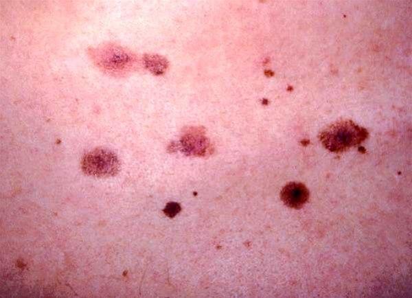 Multiple irregulære nevi hos pasient med dysplastisk nævussyndrom. Typisk er store nevi med diameter mellom 0,5-1 cm. Noe uregelmessig pigmentering er ikke uvanlig, men legg merket til fortsatt fin og  jevn pigmentering ut mot kantene. Nevus til høyre representerer dysplastisk nevus, disse har noe større variasjon i pigmentering og avgrensning.