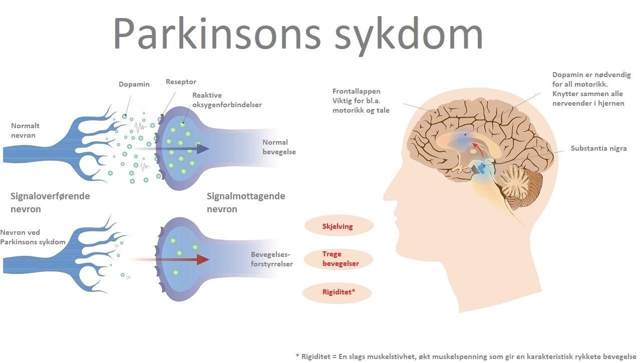 Parkinsons disease