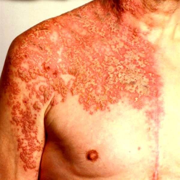 Herpes zoster gir grupperte vesikler på erythematøs bunn, som regel ikke å så alvorlig grad som på bildet. Utbredelse langs dermatom og halvsidig utbredelse er typisk, men ikke absolutt.