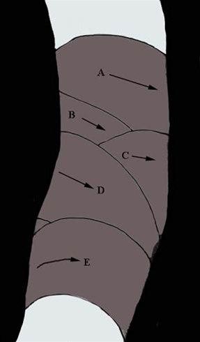Albueteiping bilde#4