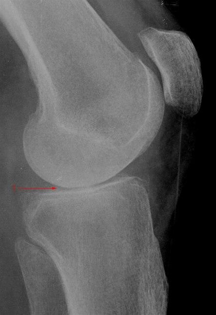 Gonartrose, moderat, side