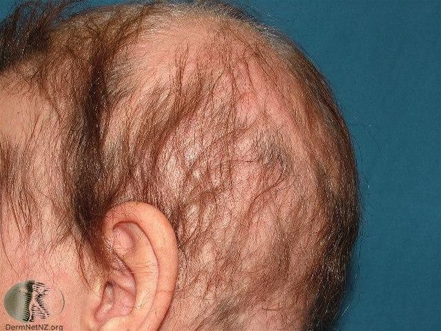 Fotoet viser alopesia, diffus