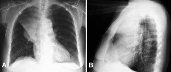 Lungekreft, front og side