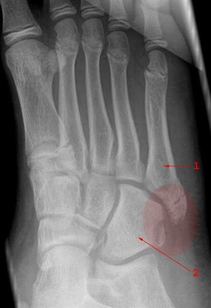 Cuboid metatars fraktur