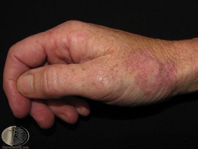 Fotoet viser Mb Bowen er en in situ-variant som over tid utvikler seg til infiltrerende spinocellulært carcinom