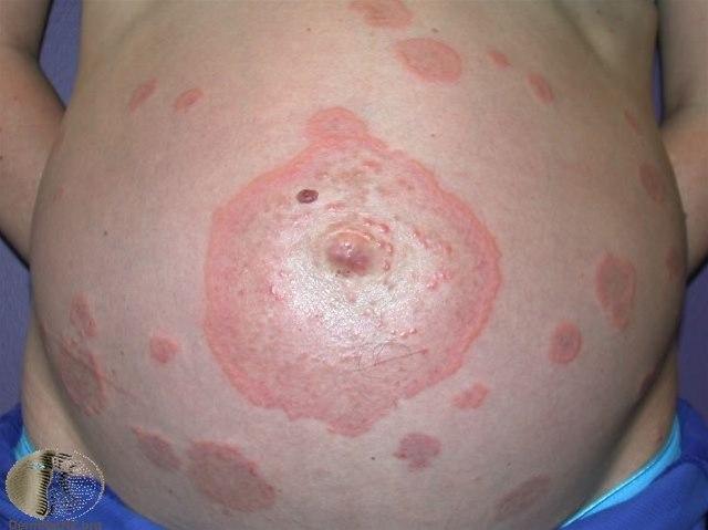 Fotoet viser svangerskaps-pemfigoid på gravidmage