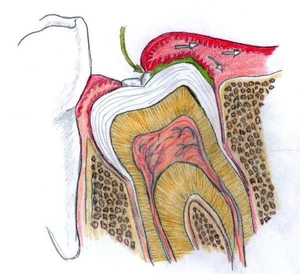 Illustrasjon av perikoronitt