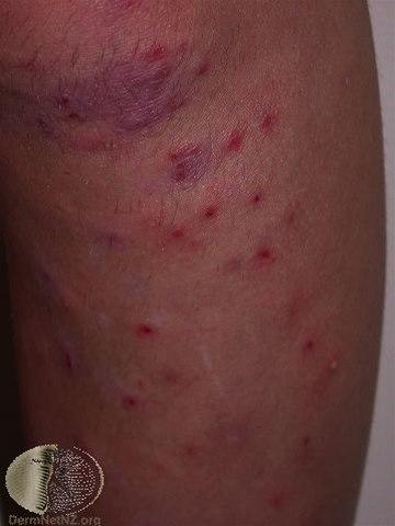 Fotoet viser follikkulitt, legger