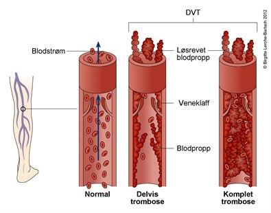 DVT dyp venetrombose