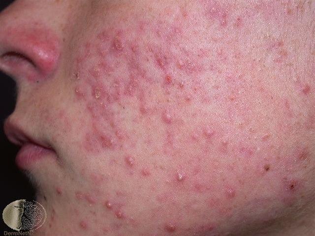 Fotoet viser papulopustuløs akne