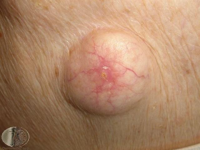 Fotoet viser epidermoid cyste lukket