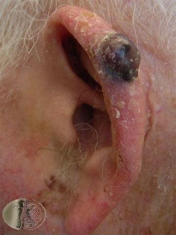 Fotoet viser malignt melanom, nodulært