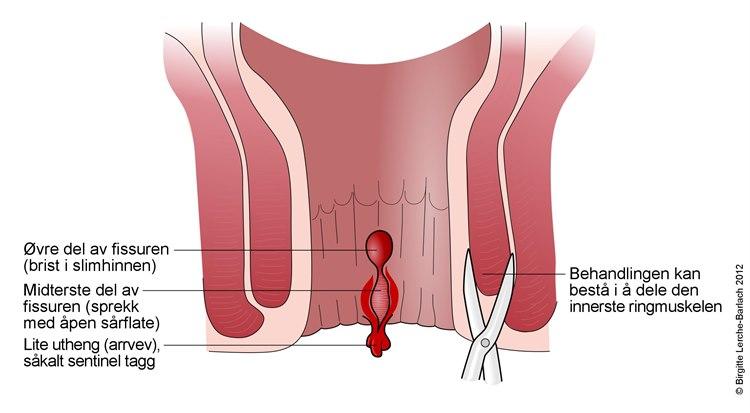 Analkanalen med fissur
