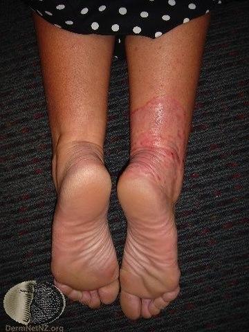 Fotoet viser tinea corporis på legg