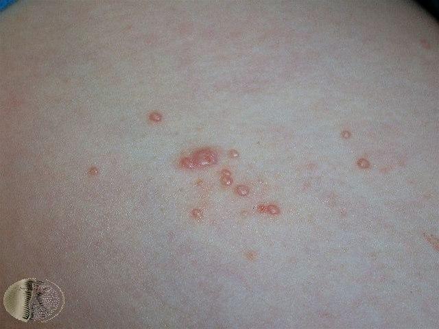 Fotoet viser molluscum contagiosum