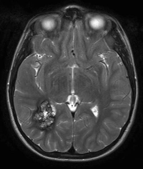 kavernøst hemangiom 2
