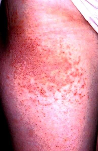 Kontaktallergisk eksem