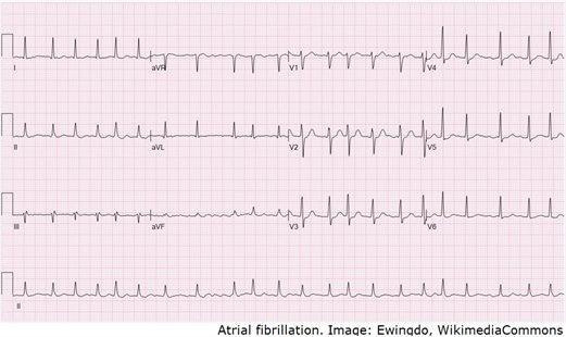 Atrial Fibrillation 132