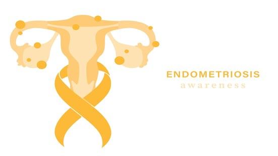 Tegning som illustrerer endometriose