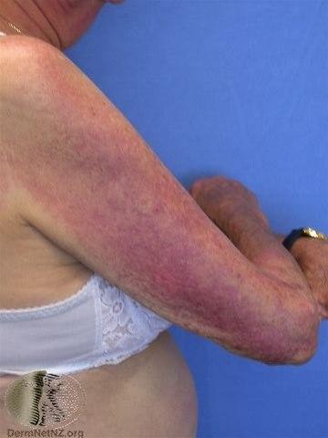 Dermatomyositt på overarmen