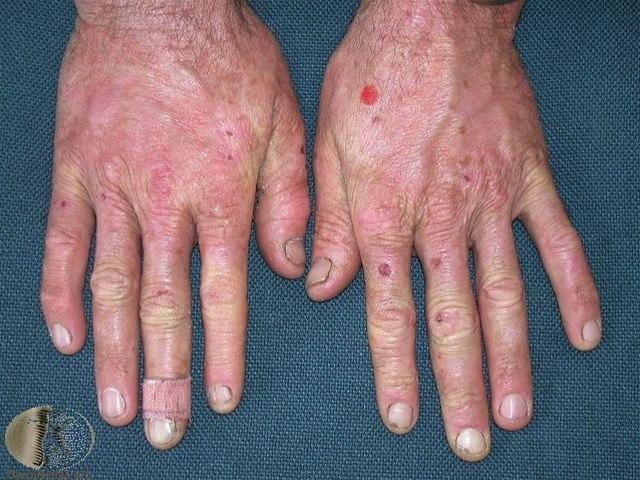 Fotoet viser porfyria cutanea tarda