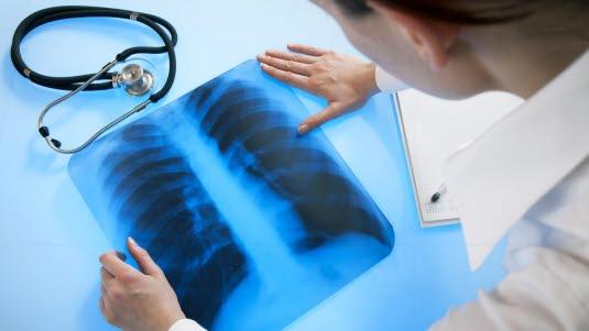 Røntgen av lungene