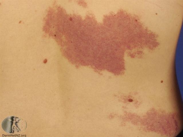 Fotoet viser hemangiom, regresjonsfase